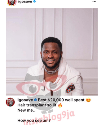 Comedian IGoSave Spends $20K On Hair Transplant